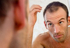 Hair Loss Man